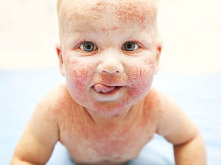 Аллергия у детей: причины, симптомы, лечение